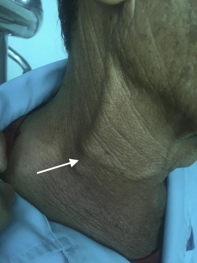 This clinical photograph shows a close-up, lateral view of the right side of an elderly patient's neck, focusing on the lower cervical region. A white arrow points to a distinct, localized swelling located along the anterior border of the right sternocleidomastoid muscle. Visible distension and prominence of the right external jugular vein are observed, suggesting impaired venous return or increased central venous pressure. The overlying skin exhibits age-related changes, including fine wrinkling and solar lentigines. Clinically, these findings represent external manifestations of venous congestion, which may be secondary to superior vena cava syndrome or right atrial compression, leading to internal jugular vein thrombosis. This image serves as an educational example of physical signs associated with thoracic or abdominal masses impacting cardiac inflow.