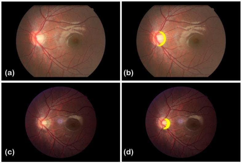 This clinical imaging set presents a longitudinal comparison of fundus photographs from a myopic patient, captured in 2012 (top row, a and b) and 2016 (bottom row, c and d). The images demonstrate the progression of peripapillary atrophy, a common feature in high myopia. Panels (a) and (c) show the raw fundus photography of the left eye, centered on the posterior pole including the optic disc, macula, and retinal vasculature. Panels (b) and (d) are annotated versions where the peripapillary atrophic arc is highlighted in yellow adjacent to the temporal margin of the optic disc. Clinically, the case tracks a transition from mild atrophy in 2012 (spherical equivalent -2.50 D, axial length 25.04 mm) to moderate atrophy in 2016 (spherical equivalent -5.50 D, axial length 27.47 mm). The visual comparison highlights changes in the morphology and extent of the atrophic region relative to the optic disc over a four-year interval, providing a visual record of myopic chorioretinal degeneration.