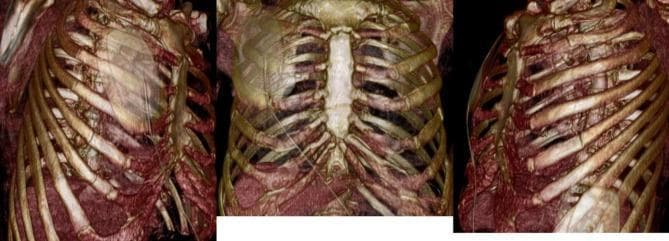 This diagnostic image consists of three panels showing 3D volume-rendered CT reconstructions of a human thoracic cage in various orientations (right oblique, anterior, and left oblique views). The visualization highlights the skeletal anatomy of the ribcage and sternum using a brownish-gold color scale for bone density. Key anatomical features visible include the manubrium and body of the sternum, the costal cartilages, and the curvature of the ribs as they extend from the thoracic spine. In the anterior and oblique views, there is a visible indentation or 'anterior chest window' deformity, suggesting a traumatic flail chest or structural instability of the sternocostal junction. The 3D rendering provides high-resolution detail of the bony integrity and spatial alignment, which is clinically significant for evaluating paradoxical chest wall movement and planning surgical stabilization, such as the Nuss procedure or internal rib fixation. Deep to the ribcage, soft tissue densities of the thoracic cavity are partially visible due to adjusted transparency settings on the CT workstation.