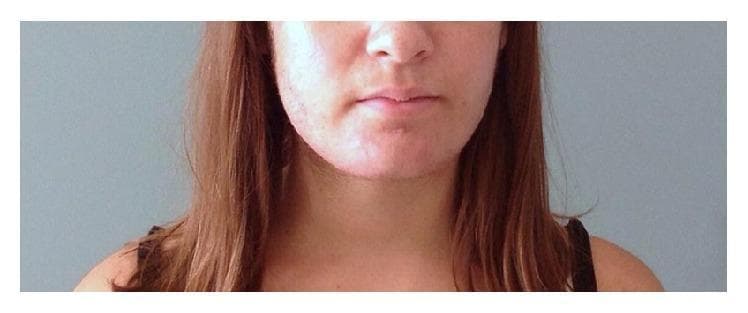 This clinical photograph displays the lower face and neck of a female patient six months postpartum, illustrating symptoms of virilization. The primary visual finding is hirsutism, characterized by prominent, dark terminal hair growth along the cheeks, jawline, and chin. The skin in the perioral and mandibular regions shows subtle textural irregularities and evidence of acneic lesions, which are common dermatological manifestations of hyperandrogenism. This image serves as an educational example of the clinical presentation of androgen-secreting conditions during or after pregnancy, such as a pregnancy luteoma. The photograph documents the residual physical effects of severe hyperandrogenemia (elevated testosterone and androstenedione) as it gradually resolves following medical or surgical intervention.