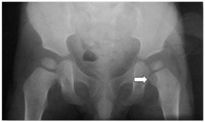 This anterior-posterior (AP) radiograph of a pediatric pelvis and proximal femurs demonstrates a focal osteolytic lesion in the proximal metaphysis of the left femur, marked by a white arrow. The lesion presents as a well-defined, radiolucent area situated just distal to the growth plate (epiphyseal plate). The surrounding cortical bone appears thinned, and the internal architecture of the lesion lacks calcification or an evident matrix. Key anatomical structures visible include the iliac wings, sacroiliac joints, pubic symphysis, and both hip joints. The femoral heads appear well-seated within the acetabula. In a pediatric clinical context involving fever and hip pain, this radiographic finding is highly suggestive of acute hematogenous osteomyelitis or a Brodie's abscess. The educational focus of the image is the identification of early lytic bone changes in pediatric musculoskeletal infection and the anatomical localization of metaphyseal lesions in long bones.