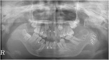 This postoperative panoramic radiograph (orthopantomogram) illustrates the surgical reconstruction of the left temporomandibular joint (TMJ). A costochondral graft is visible, positioned to replace the left mandibular condyle and restore joint function. The graft is rigidly secured to the lateral aspect of the left mandibular ramus using five radiopaque bicortical screws, which are arranged in a staggered linear pattern. The dental arches show mixed dentition with several developing permanent teeth and orthodontic considerations. This imaging is used in oral and maxillofacial surgery to evaluate the stability of rigid internal fixation, the alignment of the reconstructed condyle-ramus unit, and the postoperative anatomical relationship within the glenoid fossa. The educational focus is on the management of TMJ ankylosis and the use of autogenous rib grafts for functional mandibular reconstruction.