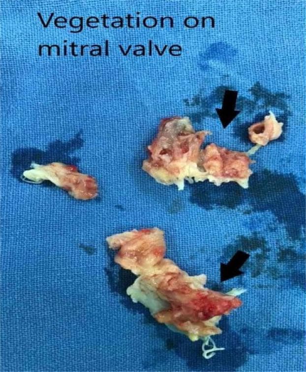 A clinical gross pathology photograph of surgically excised vegetations and destroyed mitral valve leaflets, placed on a blue surgical drape. The specimen consists of three irregular, friable tissue fragments with a variegated appearance, ranging from creamy white/yellowish tissue to deep red hemorrhagic areas. The texture is markedly rough, lobulated, and fragmented. Black arrows indicate specific areas of destroyed valvular tissue and large vegetations typical of infective endocarditis. Fine, white, filamentous chordae tendineae-like structures are visible attached to the lower tissue mass. The image demonstrates the extensive macroscopic damage and bulk of vegetation that can lead to valvular insufficiency and high embolic risk, requiring surgical intervention such as valve replacement. This visual is representative of advanced infective endocarditis affecting the mitral valve apparatus.