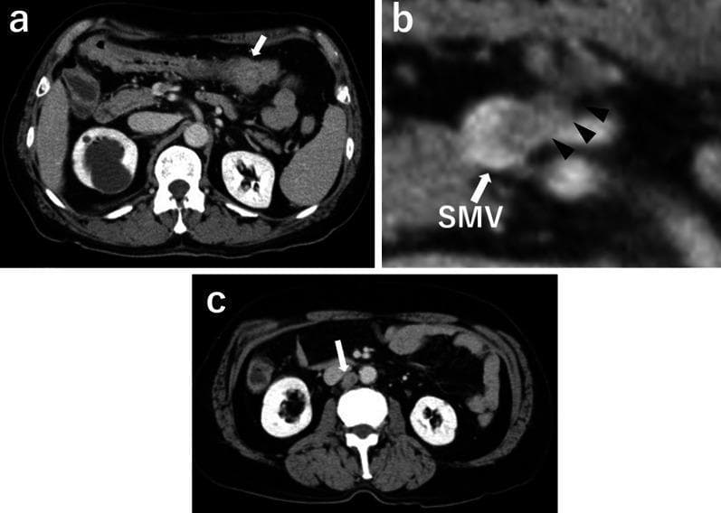 This composite diagnostic image consists of three axial contrast-enhanced abdominal CT scans (a, b, c) demonstrating advanced transverse colon cancer and associated metastatic spread. Panel A shows a primary irregular, enhancing soft tissue mass in the transverse colon (white arrow). Panel B provides a magnified view of the mesenteric region, identifying metastatic lymphadenopathy (black arrowheads) in close proximity to and invading the superior mesenteric vein (SMV). Panel C illustrates further regional progression with a prominent paraaortic lymph node metastasis (white arrow) located near the inferior vena cava and aorta. The primary tumor demonstrates asymmetric bowel wall thickening and heterogenous enhancement, while metastatic nodes appear as rounded, enhancing structures. These images are clinically significant for the staging of colorectal malignancy, specifically highlighting vascular invasion (SMV) and distant lymphatic spread (paraaortic) which classify the disease as advanced stage.
