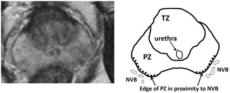 An educational figure combining an axial MRI image (left) and a corresponding anatomical schematic (right) of the prostate gland. The content illustrates the zonal anatomy of the prostate and its spatial relationship to adjacent structures. The diagram identifies the transition zone (TZ) as the central region, containing the urethra. Surrounding the posterior and lateral aspects of the TZ is the peripheral zone (PZ). Notably, the schematic highlights the 'edge of PZ in proximity to NVB' using a dotted line, where the peripheral zone borders the bilateral neurovascular bundles (NVB). This clinical illustration is designed to teach the anatomical landmarks relevant to focal therapies, such as High-Intensity Focused Ultrasound (HIFU), where the distance between the treatment area in the peripheral zone and the neurovascular bundle is a critical factor for preserving post-operative erectile function. The modality demonstrated is T2-weighted magnetic resonance imaging, which provides the soft-tissue contrast necessary to distinguish between prostatic zones.