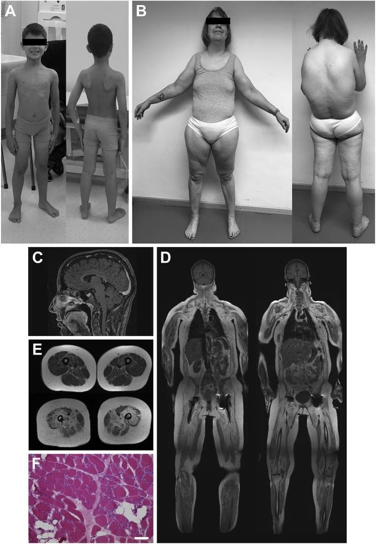 This composite educational image illustrates the clinical, radiological, and histological manifestations of Congenital Muscular Dystrophy (CMD) associated with bi-allelic INPP5K mutations. (A-B) Clinical photographs show pediatric and adult patients displaying characteristic proximal muscle atrophy, particularly in the shoulder girdle and posterior thighs, along with a wide stance and 'hunchback' (kyphosis). Adult patients demonstrate severe limitation in arm elevation (max 45°). (C-E) T1-weighted MRI sequences include a sagittal cranial view showing mild global brain atrophy and coronal whole-body and axial thigh views showing advanced progressive muscle atrophy and extensive fatty replacement (degeneration) of muscle tissue, most notably in the vastus medialis, rectus femoris, and semimembranosus. (F) A muscle biopsy specimen (H&E stain) demonstrates classic dystrophic features: marked variation in fiber size, rounding of myofibers, increased endomysial collagen (fibrosis), and areas of fatty degeneration (clear spaces). This collection serves as a reference for diagnosing syndromic CMD presenting with cataracts and intellectual disability.