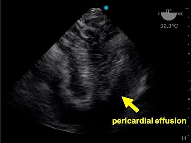 This diagnostic image is a transesophageal echocardiogram (TEE) demonstrating a mid-esophageal four-chamber view of the heart. The ultrasound captures the right and left atria and ventricles. A significant clinical finding is highlighted by a yellow arrow and text label: an anechoic (dark) space surrounding the cardiac structures, consistent with a pericardial effusion. In the clinical context of cardiopulmonary resuscitation, this finding is highly suggestive of cardiac tamponade as a potential reversible cause of cardiac arrest. Technical data on the display include a multiplane angle indicator at 0 degrees and a probe temperature reading of 32.3°C. The image serves as an educational example of using point-of-care TEE in emergency medicine and critical care to identify life-threatening obstructive pathology during advanced life support (ALS).