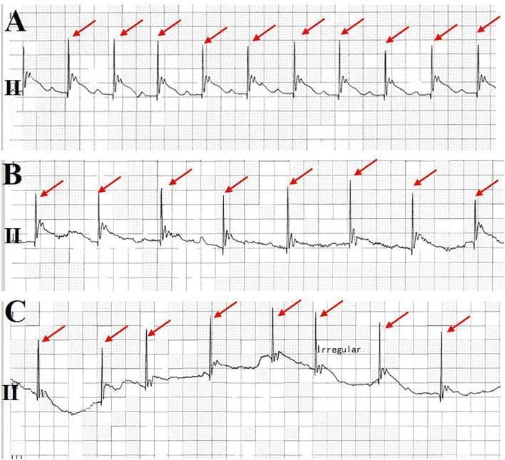 This diagnostic image shows a three-panel electrocardiogram (ECG) rhythm strip from lead II, demonstrating a progressive pacemaker malfunction characterized by loss of ventricular capture. Panel A illustrates effective ventricular pacing, where each pacing spike (marked by red arrows) is followed by a narrow QRS complex and T wave at a regular interval. Panel B shows emerging instability, with pacing spikes followed by inconsistent or altered QRS morphologies, suggesting intermittent capture. Panel C displays a frank loss of capture and pacing failure; several pacing spikes occur without subsequent QRS complexes, resulting in a slow, irregular underlying ventricular rhythm labeled as 'Irregular.' This sequence is a critical clinical illustration of pacemaker exit block or threshold elevation, which in this context is associated with acute myocardial infarction (AMI). The content is designed for intermediate to advanced medical learners focusing on cardiology, critical care, and rhythm strip interpretation.
