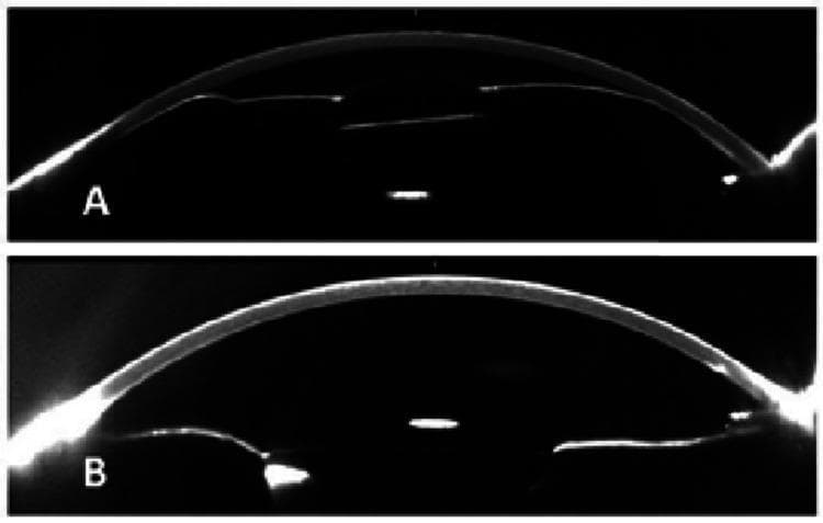 This diagnostic image pair features Scheimpflug photographs of the eye's anterior segment, illustrating the clinical management of vitreociliary block (aqueous misdirection syndrome). Figure A shows a cross-sectional view of an eye with a severely shallow anterior chamber. The iridocrystalline diaphragm is significantly displaced anteriorly, bringing the iris and intraocular lens (IOL) into close proximity with the posterior corneal surface, a hallmark of malignant glaucoma. Figure B shows the same eye immediately following a Nd:YAG laser hyaloidotomy. There is a marked increase in anterior chamber depth and volume as the iridocrystalline diaphragm shifts posteriorly to a more physiological position. These images serve as an educational comparison of pre- and post-procedural states, demonstrating the effectiveness of laser intervention in restoring normal anterior segment anatomy and resolving anterior chamber flattening caused by abnormal fluid dynamics behind the vitreous.