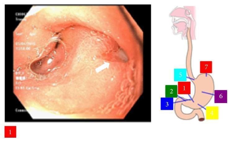 This composite educational image features an upper gastrointestinal endoscopy view of the stomach and an anatomical diagram of the upper digestive tract. The endoscopic image displays the gastric antrum, specifically highlighting a deep, nonbleeding penetrating ulcer on the posterior wall. The ulcer presents as a well-circumscribed lesion with a dark, necrotic-appearing base, approximately 7mm in diameter. A white arrow points to a small amount of extruding material adjacent to the ulcer edge. The surrounding gastric mucosa shows signs of inflammation, characterized by erythema and distorted, thickened rugal folds indicative of localized edema. To the right, a schematic illustration of the esophagus and stomach includes color-coded numerical labels (1 through 7) marking key anatomical regions: the cardia, fundus, body, antrum, and pylorus. This visual is intended to teach clinical findings of peptic ulcer disease and the endoscopic appearance of penetrating gastric lesions, relevant to gastroenterology and internal medicine.