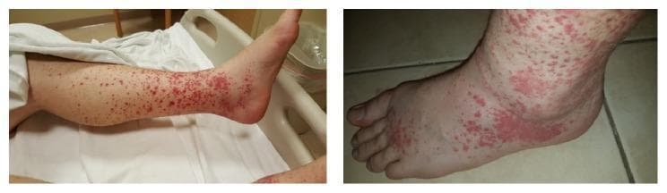 Clinical photograph of the lower extremities demonstrating classic palpable purpura, a hallmark of small-vessel vasculitis such as IgA vasculitis (Henoch-Schönlein purpura). The images show multiple erythematous to violaceous, non-blanching macules and papules. The lesions exhibit a dependent distribution, being most densely concentrated around the ankles and dorsal aspect of the feet, with progressive thinning toward the knees and mid-calf. In areas of high density, particularly the distal leg and ankle, individual purpuric spots coalesce into larger, confluent ecchymotic patches. Significant soft tissue edema is visible around the ankle and foot, evidenced by a loss of anatomical landmarks and a shiny appearance of the skin surface. This clinical presentation illustrates the typical cutaneous manifestation of leukocytoclastic vasculitis, characterized by inflammatory cell infiltration and hemorrhage within the superficial dermis. The presence of concurrent edema suggests systemic involvement or localized inflammation associated with the underlying vasculitic process.