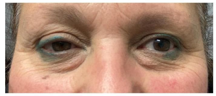This clinical photograph shows a close-up, frontal view of a patient's periorbital region, demonstrating the classic triad of Horner syndrome on the left side. Key diagnostic features include visible ptosis (drooping) of the left upper eyelid and mild elevation of the left lower eyelid (inverse ptosis), resulting in a narrowed palpebral fissure. Comparison of the pupils reveals miosis (constriction) of the left pupil compared to the right, indicating an anisocoria that is typically more pronounced in dim light. The surrounding skin exhibits signs of aging, including rhytids (wrinkles) and mild dermatochalasis. The patient has blue cosmetic tattooing or permanent eyeliner on both the upper and lower eyelids. This presentation is characteristic of a disruption in the oculosympathetic pathway, which in this clinical context followed the surgical resection of a parapharyngeal space schwannoma involving the cervical sympathetic chain.