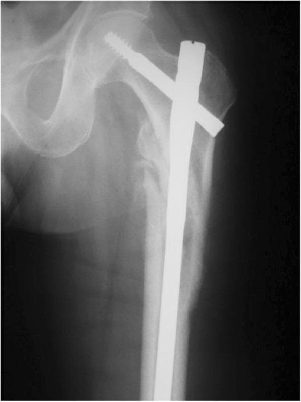 This anteroposterior (AP) x-ray radiography shows the surgical fixation of an intertrochanteric femoral fracture using a long cephalomedullary nail. The orthopedic construct consists of a radiopaque intramedullary nail inserted into the femoral shaft, with a thick cephalic lag screw and a secondary integrated stabilization pin (anti-rotation pin) extending proximally through the femoral neck and into the femoral head. The imaging demonstrates the fracture site located between the greater and lesser trochanters, showing signs of surgical reduction and stabilization. The cortical margins of the proximal femur appear irregular and disrupted consistent with a high-energy or unstable fracture pattern (OTA/AO type 31). This diagnostic image illustrates the standard of care for stabilizing extracapsular hip fractures to facilitate weight-bearing and bone union while preventing collapse or varus deformity. Relevant for orthopedic trauma education, specifically in understanding intramedullary fixation mechanics and proximal femoral anatomy.