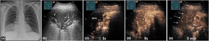 Multi-modal diagnostic imaging of community-acquired pneumonia in a 37-year-old female. Panel (a) is a posterior-anterior chest X-ray showing right-sided basal consolidation. Panel (b) is a B-mode Lung Ultrasound (LUS) demonstrating an inhomogeneous, hypoechoic consolidation with visible air bronchograms (arrows). Panels (c), (d), and (e) present a Contrast-Enhanced Ultrasound (CEUS) time-series. At 3 seconds (c), the consolidation shows an inhomogeneous pulmonary arterial enhancement pattern with a significant non-perfused area (NPA), representing a primary absence of pulmonary arterial perfusion. At 9 seconds (d), the consolidation displays delayed secondary bronchial arterial perfusion within the previously non-perfused tissue. At 3 minutes (late phase, e), the area remains demarcated as a hypoechoic region (arrows). The sequence illustrates the hemodynamic differentiation between pulmonary and bronchial arterial blood supply in pneumonic lung tissue, highlighting the utility of CEUS in evaluating complex perfusion disturbances in pulmonary pathology.