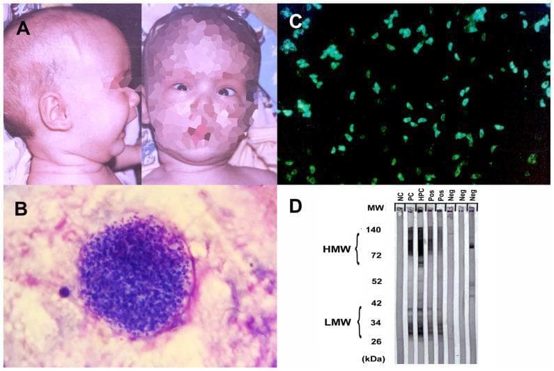 A multi-panel figure illustrating clinical, histopathological, and serological diagnostic findings for parasitic central nervous system infections. Panel A presents clinical photographs of an infant exhibiting macrocephaly and the 'sunset eye sign' (downward gaze with visible sclera above the iris), characteristic of hydrocephalus due to congenital toxoplasmosis. Panel B is a high-power light microscopy image of a Toxoplasma gondii tissue cyst in the brain, containing numerous densely packed bradyzoites. Panel C shows an indirect immunofluorescence assay (IFA) demonstrating bright green peripheral fluorescence of Toxoplasma tachyzoites, indicating positive anti-Toxoplasma antibodies. Panel D displays a Western blot analysis for toxocariasis. It compares patient samples against negative (NC), positive (PC), and high-positive (HPC) controls. The presence of low molecular weight (LMW) bands, specifically between 26 and 34 kDa, is the diagnostic criteria for positive Toxocara serology, while high molecular weight (HMW) bands are also visible in positive samples. The composite serves as an educational tool for identifying physical signs and interpreting specialized laboratory assays in neuroparasitology.
