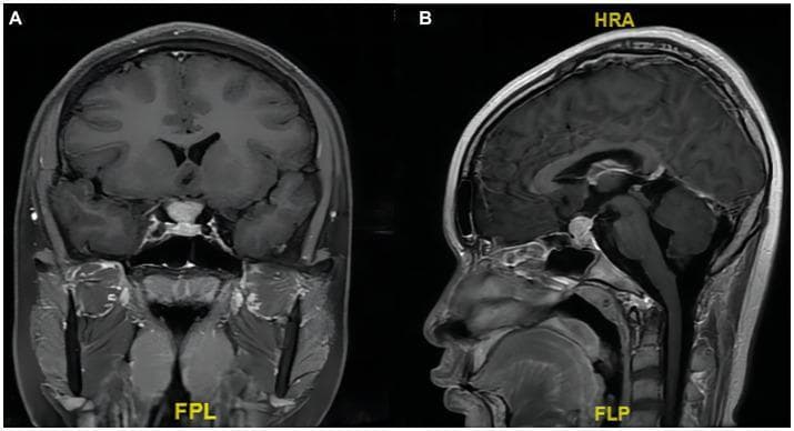 Contrast-enhanced T1-weighted MRI of the head in coronal (A) and sagittal (B) planes, focused on the sellar and suprasellar regions. The imaging reveals a significant homogeneous enhancement of an enlarged pituitary stalk, measuring approximately 12 x 15 x 16 mm. This mass and the normal pituitary gland are both bounded superiorly by the diaphragma sellae. Notable mass effect includes slight compression of the optic chiasm and a focal depression of the sellar floor toward the left side. The cavernous sinuses bilaterally appear clear of tumor invasion. Additionally, the images show mucosal thickening in the ethmoid and left maxillary sinuses. This diagnostic imaging is indicative of pathology involving the infundibulum, such as lymphocytic hypophysitis or a primary pituitary stalk tumor like marginal zone lymphoma (MZL). The study demonstrates key landmarks for neurosurgical planning, including the relationship between the lesion, the sella turcica, and the visual pathways.