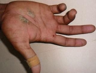 Clinical photograph of a right hand demonstrating ulnar claw hand (main en griffe) deformity, secondary to traumatic ulnar nerve injury. The image shows characteristic hyperextension at the fourth and fifth metacarpophalangeal (MCP) joints, accompanied by fixed flexion at the proximal and distal interphalangeal (PIP and DIP) joints of the ring and little fingers. In addition to the neurological deficit, the palmar surface exhibits multiple signs of acute trauma, including two irregular areas of pale/abrasive discoloration on the palm and a small punctate wound near the base of the index finger. An adhesive bandage is visible on the thumb. This visual presentation is classic for a distal or high ulnar nerve palsy where the loss of intrinsic muscle function (lumbricals and interossei) leads to an imbalance in the hand's extrinsic musculature. The image serves as an educational tool for identifying physical signs of peripheral nerve compression or transection following orthopedic trauma, such as a humeral shaft fracture.