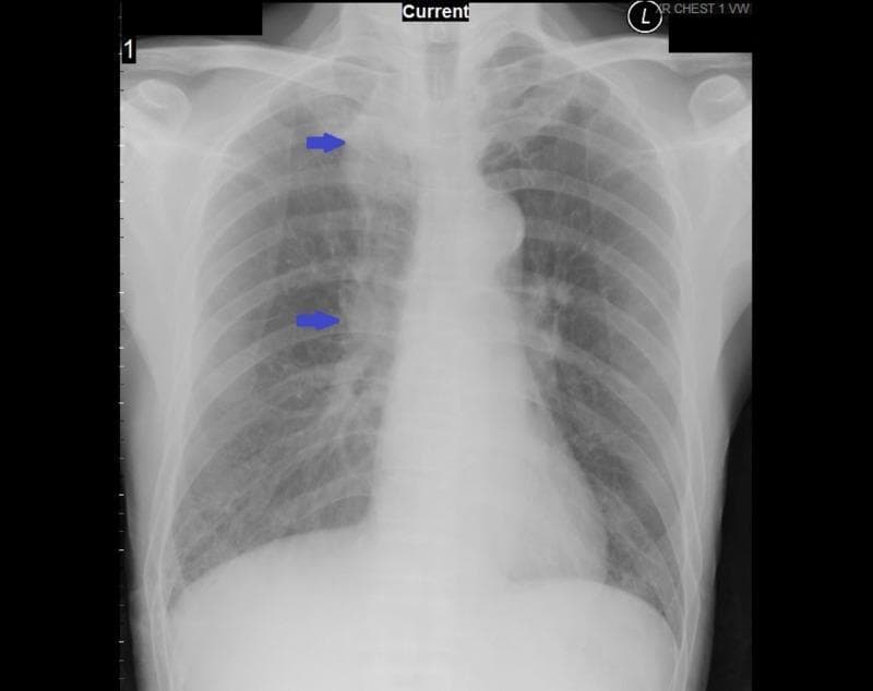 This diagnostic image is a posterior-anterior (PA) chest X-ray demonstrating several key clinical findings in a patient with a history of lung cancer. The primary feature includes postoperative changes in the right lung, specifically a reduction in lung volume consistent with a prior right upper lobe lobectomy. There is evidence of pulmonary fibrosis, visualized as patchy, increased interstitial opacities and thickening, which is more pronounced in the right lung field. Blue arrows point toward the mediastinal region, highlighting borderline enlarged lower mediastinal lymph nodes situated adjacent to the distal esophagus. The right hemithorax shows architectural distortion, while the left lung field appears relatively clearer but with subtle reticular markings. The skeletal structures, including the clavicles and scapulae, are partially visible at the periphery. This radiograph serves as an educational example of assessing chronic parenchymal changes and hilar/mediastinal lymphadenopathy in a post-surgical oncological context.