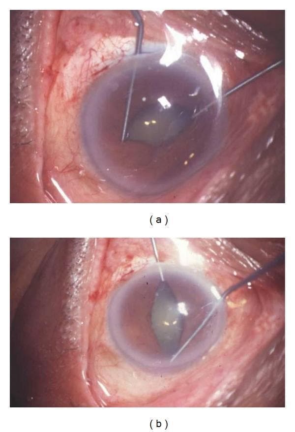 Two intraoperative clinical photographs (a and b) demonstrate the use of Kuglen hooks for mechanical pupillary dilation during ophthalmic surgery. The images show a close-up of a human eye with two metallic, angled Kuglen hooks inserted into the anterior chamber. The hooks are positioned at opposite margins of the iris, applying outward traction to stretch the pupil. In frame (a), the traction is applied horizontally, resulting in an elongated, oval-shaped pupil. In frame (b), the hooks are used in a perpendicular orientation to further expand the pupillary aperture. The pupil appears irregular and non-circular due to mechanical stretching. The surrounding sclera and conjunctiva exhibit prominent perilimbal injection and vascularization, consistent with inflammation often seen in uveitic eyes undergoing cataract surgery. The cornea appears slightly hazy, and the ocular surface is moist with visible light reflections. These maneuvers are typically employed to manage small pupils or lyse posterior synechiae to ensure adequate visualization of the lens and capsule during phacoemulsification.