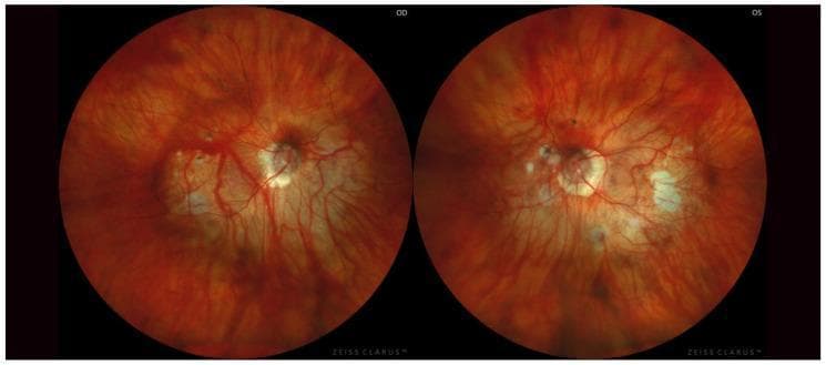 Clinical photograph of the ocular fundus of both eyes (OD and OS) from a single patient, demonstrating advanced pathological changes associated with high myopia and symmetric Type I posterior staphyloma according to Curtin’s classification. Both images show a characteristic 'tessellated' appearance due to retinal pigment epithelium thinning. The optic discs in both eyes appear abnormally large and tilted with significant excavation (cupping), surrounded by extensive peripapillary chorioretinal atrophy. Multiple patches of white-to-pale yellow lacquer cracks and chorioretinal atrophic lesions are visible, particularly in the macula and peripapillary regions. The retinal vasculature exhibits stretching and straightening, with visible underlying choroidal vessels. The overall presentation illustrates a posterior staphyloma where the posterior pole is abnormally ectatic, leading to significant thinning of the retina and choroid. This educational material is relevant for ophthalmology, specifically for studying the progression and clinical manifestations of pathologic myopia and staphyloma classification.
