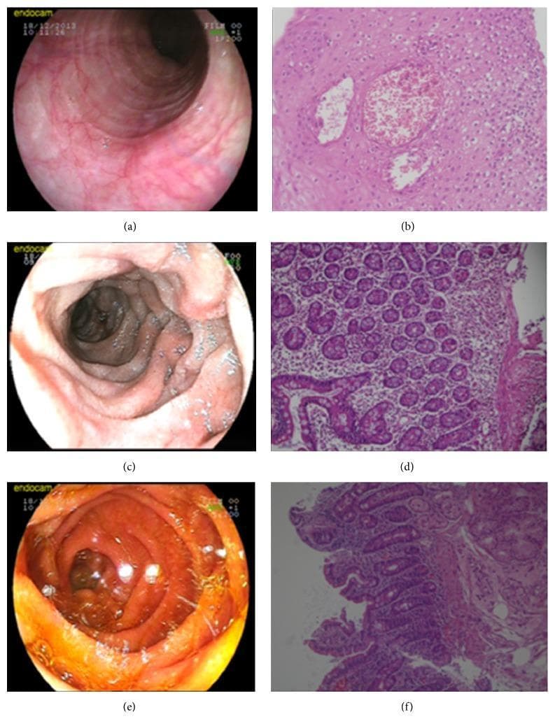 This composite figure illustrates the endoscopic and histological findings of eosinophilic gastroenteritis across three stages (initial presentation and follow-up). (a) Endoscopy of the esophagus shows classic 'felinization' characterized by concentric mucosal rings. (b) Corresponding H&E-stained esophageal biopsy (200x) displays a dense eosinophilic microabscess within the squamous epithelium. (c) Duodenal endoscopy reveals significant mucosal edema, congestion, and luminal narrowing. (d) H&E-stained duodenal biopsy (200x) demonstrates marked eosinophilic infiltration and inflammatory cells within the lamina propria and submucosa, disrupting normal architecture. (e) Follow-up endoscopy after three months of steroid therapy shows marked resolution of the duodenal edema and congestion. (f) Follow-up duodenal histology (200x) reveals restoration of normal mucosal architecture with resolved eosinophilic infiltration. The figure effectively contrasts diagnostic markers of eosinophilic esophagitis and duodenitis with post-treatment outcomes, emphasizing both gross endoscopic signs and microscopic cellular infiltration patterns.