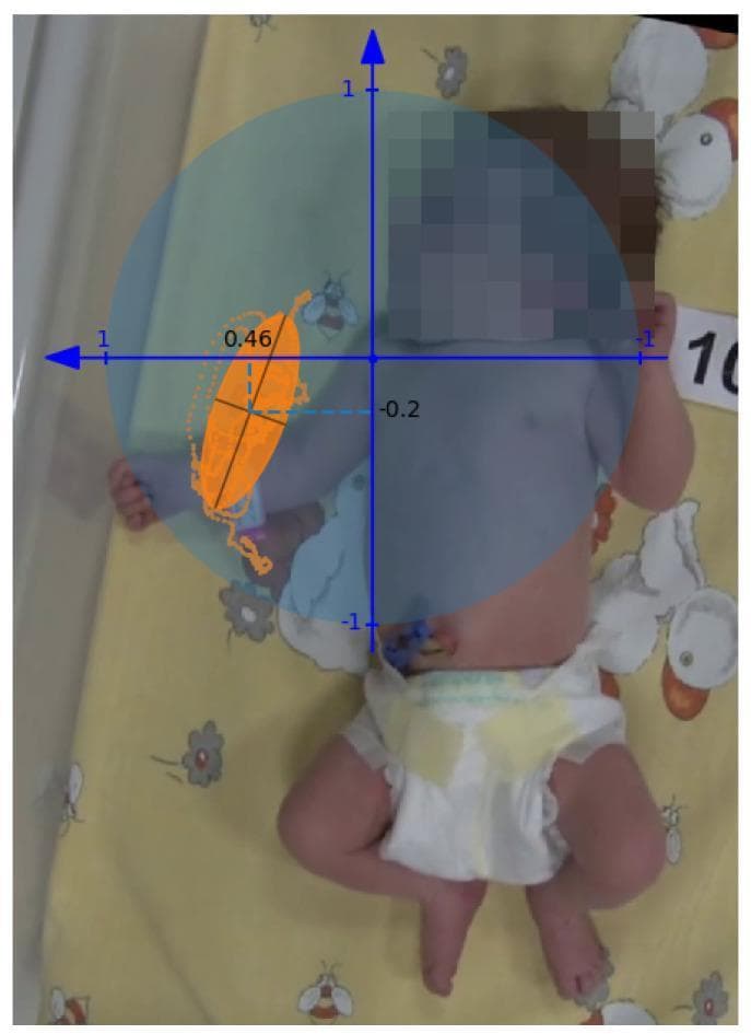 A clinical photograph of an infant in a supine position, overlaid with a motion analysis coordinate system for the General Movement Assessment (GMA). The visual illustrates the quantitative analysis of spontaneous movements, specifically writhing movements (WM). A blue Cartesian coordinate system is centered on the infant's right shoulder joint, with axes normalized to the length of the analyzed limb. The vertical axis is oriented toward the head, and the horizontal axis is oriented toward the body midline. An orange ellipse is circumscribed over the trajectory of the right wrist, representing a 30-second observation period. The ellipse features internal black lines marking its major and minor axes, with a numerical value of 0.46 indicated. A large blue shaded circle represents the maximum possible range of motion used to calculate the Fraction of Movement Area (FMA). This methodology is used in neonatal neurology to differentiate normal spontaneous movements from poor repertoire (PR) movements, serving as a diagnostic tool for early detection of neurodevelopmental disorders such as cerebral palsy.