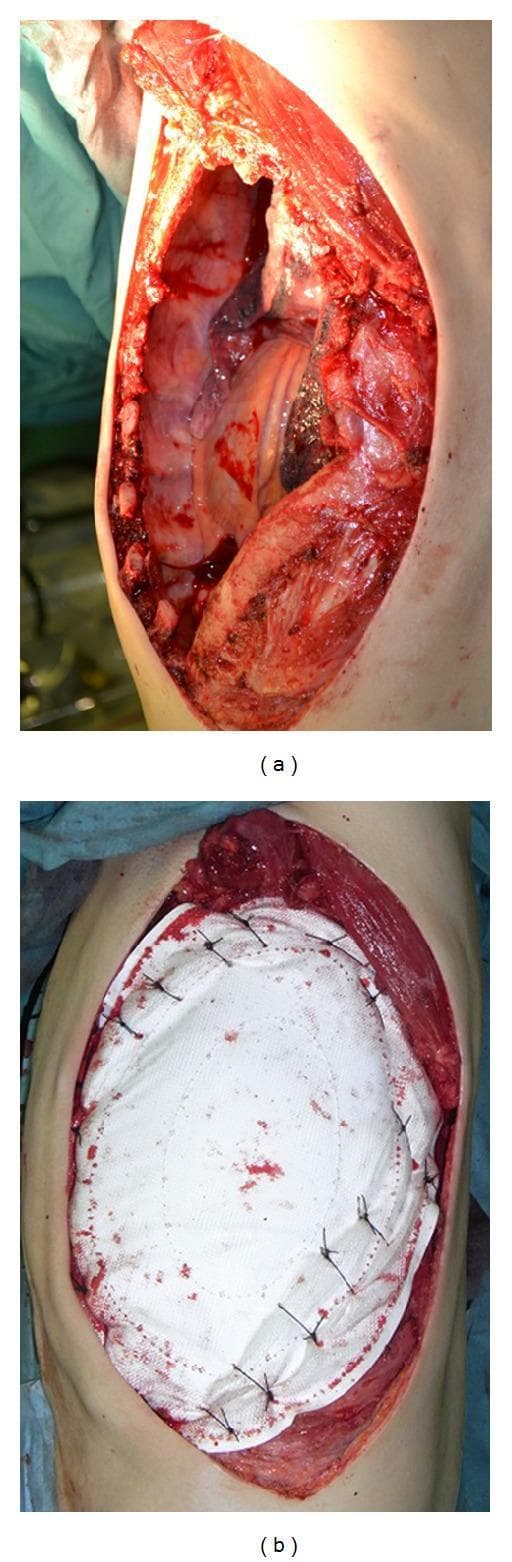 Two intraoperative clinical photographs demonstrate a thoracotomy for chest wall tumor resection and subsequent reconstruction in a 74-year-old patient. Photograph (a) shows the defect immediately following an en bloc resection of a large tumor involving the 4th through 8th ribs. The thoracic cavity is exposed, revealing internal structures, visible rib edges, and surrounding musculature. Photograph (b) illustrates the primary reconstruction phase using a Composix E/X Mesh, a dual-sided prosthesis composed of expanded polytetrafluoroethylene (ePTFE) and polypropylene. The white, elliptical mesh is seen secured to the surrounding intercostal muscles and rib margins with heavy non-absorbable sutures to restore chest wall integrity and stability. This visual serves as an educational example of managing massive chest wall defects requiring synthetic mesh stabilization to prevent paradoxical breathing and protect intrathoracic organs.