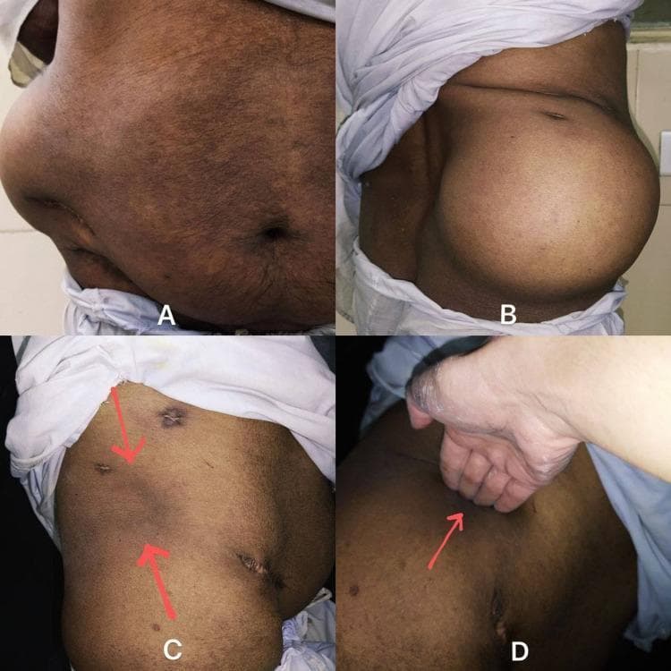 This composite of clinical photographs illustrates the physical examination findings of a right-sided lumbar hernia. Panels A (anterior view) and B (lateral view) demonstrate a large, smooth, and prominent swelling in the right lumbar region that significantly distorts the flank's contour. The overlying skin appears normal with a visible scar, indicative of a previous surgical intervention. Panel C shows the same anatomical region after the manual reduction of the hernia; red arrows indicate the site of the musculoskeletal defect. Panel D demonstrates the clinical technique for assessing the size of the abdominal wall defect, where four fingers are insinuated into the reducible space. This visual series is designed for medical education regarding the diagnosis and physical assessment of lumbar hernias (Petit's or Grynfeltt-Lesshaft hernias), emphasizing key clinical features such as reducibility, the presence of an expansile cough impulse, and the physical palpation of the fascial defect.