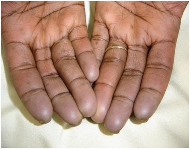This clinical photograph displays the palmar surface of both hands, illustrating classic features of Raynaud phenomenon, specifically the 'asphyxic' or cyanotic phase. The image demonstrates a clear demarcation of skin color changes: the palms retain a normal, warm-toned pigmentation, while all fingers show a distinct transition to a pale, bluish-gray or cyanotic hue starting near the metacarpophalangeal joints and intensifying towards the distal phalanges. This visual finding is characteristic of tissue hypoxia resulting from vasospasm and sluggish blood flow. In the context of the provided metadata, this manifestation is associated with systemic sclerosis (scleroderma). While the skin overall appears intact, there is evidence of subtle textural changes at the fingertips, which may precede digital pitting or sclerodactyly. The image serves as a clinical reference for the secondary Raynaud phenomenon in autoimmune connective tissue diseases, highlighting the episodic digital ischemia typical of the condition.