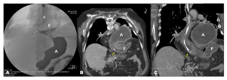 This composite figure demonstrates the progression and diagnosis of gastric pathologies using fluoroscopy and computed tomography (CT). Panel A is an anteroposterior barium swallow image showing a sliding hiatal hernia. The gastroesophageal junction (indicated by a white arrow) and a portion of the gastric fundus (F) are seen herniated above the diaphragm, while the gastric antrum (A) remains in the subdiaphragmatic abdominal cavity. Panels B and C are coronal-oblique contrast-enhanced CT reconstructions during an acute presentation of gastric volvulus. These images reveal a significant anatomical shift: a severely dilated gastric antrum (A) has herniated into the thoracic cavity, while the fundus (F) is located inferiorly below the diaphragm. A nasogastric tube (yellow arrows) is visible traversing the esophageal hiatus, likely for gastric decompression. This comparison highlights the transition from a simple hiatal hernia to an acute, complicated mesentero-axial gastric volvulus characterized by abnormal rotation and displacement of gastric segments relative to the diaphragm.