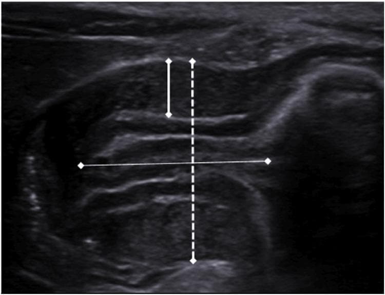 This abdominal ultrasound image captures a longitudinal view of the pylorus in a pediatric patient. The imaging displays classic diagnostic signs of Infantile Hypertrophic Pyloric Stenosis (IHPS). The pyloric muscle is significantly thickened, appearing hypoechoic and edematous, while the central mucosal layer is echogenic and compressed. White calipers demonstrate critical diagnostic measurements: a vertical measurement indicating a pyloric muscle thickness of 4.5 mm and a horizontal measurement indicating a pyloric canal length of 15 mm. The 'cervix sign' is evident due to the elongation and narrowing of the pyloric canal. Clinical significance includes the identification of gastric outlet obstruction, where the thickened muscle prevents the passage of gastric contents into the duodenum. This visual material is used to teach diagnostic criteria for IHPS, focusing on the threshold measurements (muscle thickness >3 mm and canal length >14-15 mm) essential for radiologists and pediatricians.