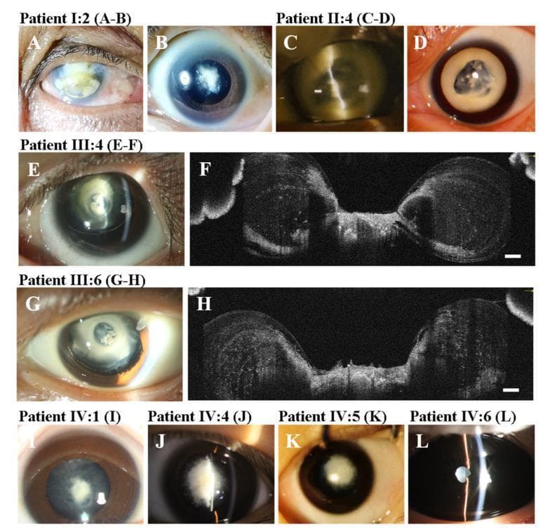 A multi-panel figure consisting of slit-lamp clinical photographs and Anterior Segment Optical Coherence Tomography (AS-OCT) images documenting phenotypic variations of congenital cataracts in a multi-generational family. The photographs (A-E, G, I-L) display a range of crystalline lens opacities, including dense nuclear cataracts, total cataracts, and keratoleukoma. Key clinical signs visible include anterior umbilication of the lens—characterized by a central indentation of the anterior lens surface—and lens subluxation (E, G). The AS-OCT cross-sections (F, H) provide high-resolution visualization of the lens architecture, confirming the presence of anterior umbilication as a central depression with an intact anterior capsule. The educational focus is on the morphological diversity of cataracts caused by genetic variants, specifically those related to the MIP gene, illustrating varying degrees of central lens opacity and structural deformation across different individuals. The images are essential for ophthalmological training in identifying anterior segment dysgenesis and congenital lens anomalies.