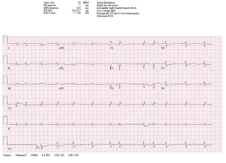 A 12-lead electrocardiogram (ECG) demonstrating an irregularly irregular rhythm characteristic of atrial fibrillation. Key morphological findings include the absence of distinct P waves, replaced by fine fibrillatory waves, and varying R-R intervals with a ventricular rate of approximately 78 BPM. The QRS duration is measured at 110 ms, with a terminal r' wave in lead V1 forming an rsr' pattern, indicative of an incomplete right bundle branch block (RBBB). Low voltage QRS complexes are noted across the limb leads, a finding often associated with infiltrative cardiomyopathies such as amyloidosis. Frontal plane axis shows right axis deviation. Precordial leads V1-V6 exhibit nonspecific ST-segment and T-wave abnormalities. This ECG provides clinical evidence of systemic disease impacting cardiac conduction and myocardial voltage, likely within the context of restrictive cardiomyopathy.