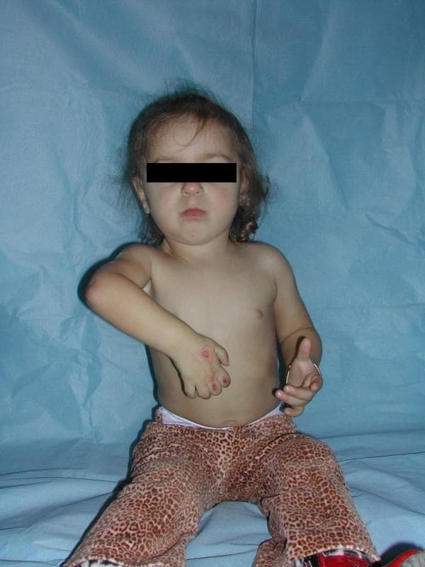 This clinical photograph shows a pediatric patient presenting with characteristic physical signs of obstetric brachial plexus palsy (specifically Waiter's Tip deformity). The left upper limb demonstrates significant pathological positioning: the shoulder is adducted and internally rotated, the elbow is extended, and the wrist and fingers are fixed in a flexed position. There are visible red, erosive skin lesions or abrasions on the dorsal aspect of the left hand, particularly over the knuckles, which can occur due to lack of sensation or inability to protect the limb (sensory deficit-related injury). The right upper limb appears relatively unaffected, positioned with slight elbow flexion and extended fingers. This image illustrates the long-term musculoskeletal consequences and secondary dermatological complications of total brachial plexus paralysis following unsuccessful neurotisation. It is an educational example of neonatal brachial plexus injury (NBPI) in a young child, highlighting limitations in shoulder abduction and external rotation.
