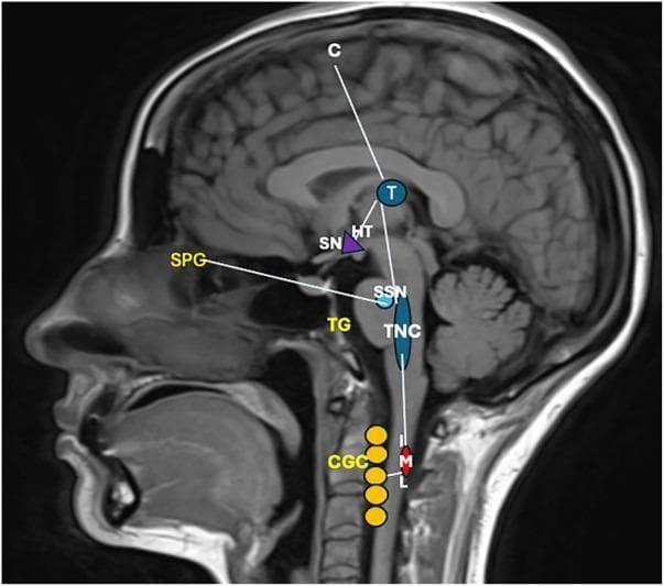 This diagnostic image consists of a midsagittal T1-weighted MRI scan of the human head and neck, overlaid with a schematic pathophysiology diagram illustrating the neuroanatomical pathways of cluster headache (CH). The diagram maps three primary systems: the trigeminovascular system, the autonomic reflex, and the hypothalamic system. Key labeled structures include the Primary Sensory Cortex (C), Thalamus (T), Hypothalamus (HT), and Suprachiasmatic Nucleus (SN). In the brainstem and peripheral regions, the diagram highlights the Superior Salivatory Nucleus (SSN), Trigeminal Caudal Nucleus (TNC), Trigeminal Ganglion (TG), and Sphenopalatine Ganglion (SPG). Descending pathways are shown reaching the Intermediolateral Nucleus (IML) of the spinal cord and the Cervical Ganglionic Complex (CGC). Functional connections illustrate nociceptive afferents from the TG to the TNC, ascending projections to the thalamus and cortex for pain perception, and hypothalamic activation of autonomic centers. This educational visual explains the clinical manifestations of CH, including trigeminal distribution pain, cranial autonomic symptoms like lacrimation via the SPG, and sympathetic dysfunction leading to Horner's syndrome via the IML-CGC pathway.