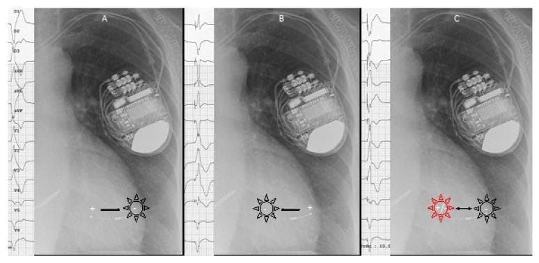 This composite educational graphic consists of three panels (A, B, and C) illustrating cardiac pacing concepts using chest X-rays, ECG tracings, and superimposed diagrams. Each panel features a chest X-ray showing an implanted cardiac device (pacemaker or ICD) in the left infraclavicular region with leads extending toward the heart. Panel A and B demonstrate conventional bipolar pacing where a depolarization wavefront (indicated by a black sunburst icon) originates solely from the cathode (-). Panel A shows the cathode on the right and anode (+) on the left, while Panel B reverses this orientation. Panel C illustrates 'pseudo-multisite pacing' (pseudo-MPP) via intentional anodal capture. It shows depolarization wavefronts originating from both the cathode and the anode (indicated by red and black sunburst icons), occurring when high-density current is applied. Adjacent to each X-ray is a 12-lead ECG strip demonstrating the resulting QRS complex morphologies. The diagram highlights how anodal capture in bipolar pacing creates a fusion QRS complex, relevant for optimizing Cardiac Resynchronization Therapy (CRT).
