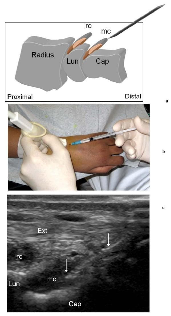 This composite educational graphic illustrates the technique for ultrasound (US)-guided puncture of the wrist joints in a patient with Juvenile Idiopathic Arthritis (JIA). Panel A provides an anatomical diagram in the sagittal plane, showing the radius, lunate (Lun), and capitate (Cap) bones. It highlights the dorsal radio-carpal (rc) and midcarpal (mc) recesses, indicating the proximal-to-distal needle trajectory. Panel B is a clinical photograph showing the procedural setup: a linear 'hockey-stick' transducer covered by a sterile sheath is held in a longitudinal orientation on the dorsal wrist, while a syringe and 23G needle are used for a free-hand puncture. Panel C displays a corresponding longitudinal sagittal US scan. In this sonogram, the extensor tendon (Ext) is visible superficially as a fibrillar, hyperechoic structure. Deeper, the hypoechoic bony cortex of the lunate (Lun) and capitate (Cap) are seen, with the midcarpal recess (mc) located between them. Hyperechoic linear echoes (arrows) represent the needle tip being successfully guided into the hypertrophic midcarpal synovial recess for corticosteroid injection.