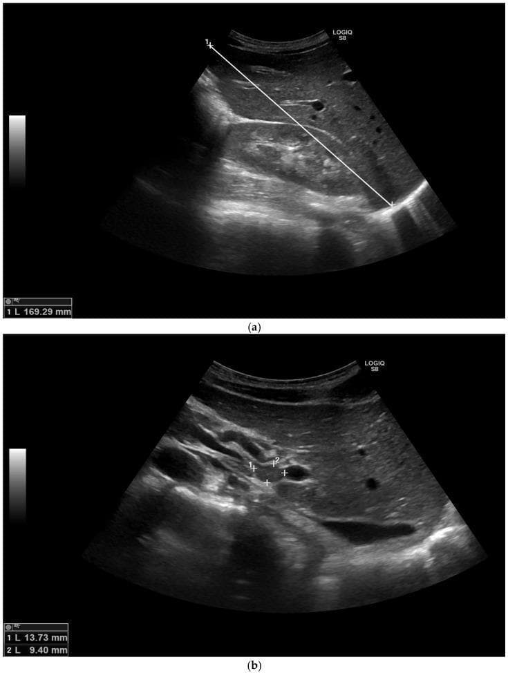Diagnostic abdominal ultrasound images demonstrating hepatomegaly and regional lymphadenopathy. (a) Longitudinal scan of the right upper quadrant showing the liver parenchyma with a speckled, homogeneous echotexture. A measurement calipers line indicates a liver span of 169.29 mm in the midclavicular line, exceeding the normal threshold of 150 mm and confirming hepatomegaly. (b) Targeted ultrasound of the porta hepatis region revealing multiple hypoechoic, well-defined rounded structures consistent with enlarged lymph nodes. Two nodes are measured at 13.73 mm and 9.40 mm, indicating portal hepatic lymphadenopathy. These findings are presented in the clinical context of a patient with elevated liver enzymes and systemic infection, such as coccidioidomycosis, highlighting the use of ultrasound for evaluating visceral involvement and identifying lymph node enlargement in infectious or inflammatory disease processes.