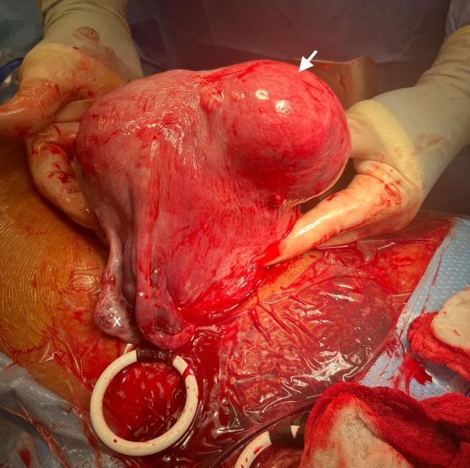 This clinical photograph captures an intraoperative view of an exteriorized uterus during a cesarean section. The primary finding is a large, well-circumscribed, subserosal uterine leiomyoma (fibroid), approximately 9 cm in size, located on the left anterior lateral uterine wall (indicated by a white arrow). The fibroid presents as a smooth, reddish-pink bulbous mass protruding from the uterine serosa. To the lower left of the primary uterine body (anatomical right), a normal right fallopian tube (marked with an asterisk) and right ovary (marked with an 'x') are clearly visualized. The uterine tissue appears hyperemic, typical of the gravid state. The surgical field includes sterile drapes, gloved hands of the surgeon, and a surgical retractor. This image serves as a significant clinical example of a large subserosal fibroid encountered during obstetric surgery and illustrates the anatomical relationships between the gravid uterus, adnexa, and intramural pathology.
