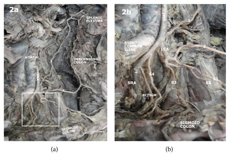This clinical photograph of a gross anatomical dissection (Figures 2a and 2b) displays the posterior abdominal wall, focusing on the arterial supply to the distal colon. The abdominal aorta is visible, giving rise to the inferior mesenteric artery (IMA). The IMA originates and subsequently branches into the left colic artery (LCA), which provides a transverse branch to the descending colon near the splenic flexure. The dissection illustrates a specific anatomical variation where the LCA continues inferiorly to give rise to multiple sigmoid arteries (labeled S1 through S4) directed toward the sigmoid colon. Further distal branching includes the rectosigmoid branch (RCTSGM) and the terminal superior rectal artery (SRA). Figure 2b provides a magnified view of the vascular bifurcation, highlighting the spatial relationship between the IMA, LCA, and the right common iliac artery. This educational material is designed to demonstrate mesenteric vascular anatomy and potential variations in the blood supply to the hindgut for surgical and anatomical study.