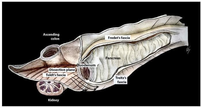 An anatomical diagram illustrating the surgical planes and fascial relationships during the Kocher maneuver, a mobilization technique used in abdominal surgery. The illustration depicts a cross-sectional view of the right upper quadrant. Key structures include the ascending colon and duodenum, both shown in cross-section. The lobulated pancreas is visible medially, adjacent to the duodenum. The diagram highlights critical retroperitoneal fascial layers: Toldt’s fascia (retrocolic fusion fascia), Treitz’s fascia (retroduodenopancreatic fusion fascia), and Fredet’s fascia (preduodenopancreatic fascia). A specific 'dissection plane' is marked with parallel lines and directional arrows, indicating the surgical path between the fusion fascia of Toldt and the fusion fascia of Treitz. This plane allows for the medial mobilization of the duodenum and pancreatic head to expose the underlying inferior vena cava and right kidney, the latter of which is shown in cross-section at the base of the diagram. This illustration is an educational tool for oncogynecologists and general surgeons to understand retroperitoneal anatomy during cytoreductive surgery.