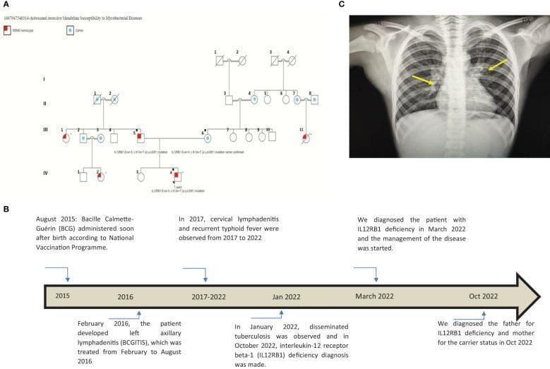 Educational composite image regarding Mendelian susceptibility to mycobacterial disease (MSMD). Panel A is a four-generation pedigree diagram illustrating autosomal recessive inheritance of an IL12RB1 mutation, with affected individuals (red) and carriers (blue dots) identified across lineages. Panel B is a clinical timeline ranging from 2015 to 2022, detailing a patient's progression from BCG vaccination to BCGitis, recurrent typhoid fever, disseminated tuberculosis, and eventual molecular diagnosis of IL12RB1 deficiency. Panel C is a posterior-anterior (PA) chest radiograph of a pediatric patient showing bilateral hilar lymphadenopathy (indicated by yellow arrows) and diffuse bilateral reticular interstitial opacities. Multiple hyperlucencies are visible in the upper and middle lobes bilaterally and the left lower lobe, findings consistent with early bronchiectasis in the context of chronic mycobacterial infection. The diagnostic focus is on primary immunodeficiency leading to severe mycobacterial pathology and associated radiological findings.