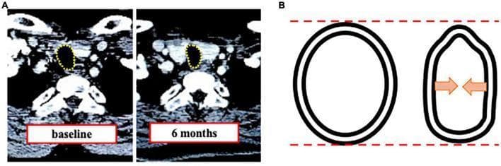 This educational image depicts tracheal stenosis following tracheostomy through two primary visual components. Panel A contains axial Computed Tomography (CT) images of the neck at two time points: baseline and 6 months post-procedure. Yellow dotted lines outline the tracheal lumen, demonstrating a transition from a wide, oval cross-section at baseline to a significantly narrowed, constricted airway at 6 months. Panel B is a comparative pathophysiology diagram illustrating the mechanism of 'triangulation.' It shows the normal, relatively circular cross-section of the trachea (left) versus the deformed state (right). Red dashed lines indicate that the vertical diameter remains relatively stable, while orange arrows highlight significant horizontal compression and inward collapse of the lateral tracheal walls. This visual comparison emphasizes that tracheal stenosis in this clinical context is primarily characterized by a reduction in horizontal diameter and a change in morphology from circular to a triangular or teardrop shape, which has critical implications for choosing endotracheal tube sizes and managing long-term airway patency.