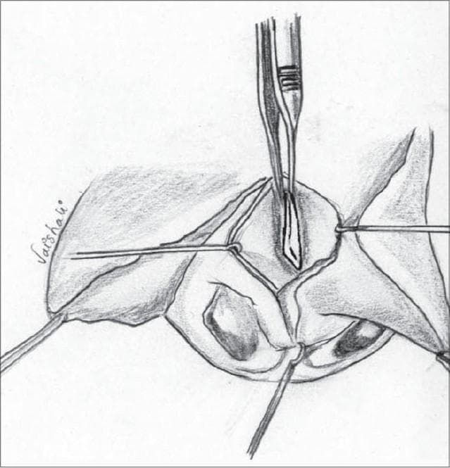 Anatomical diagram and surgical illustration detailing a key step in primary nasal correction for cleft lip or septoplasty. The drawing depicts the surgical field of the nasal septum from an anterior view. It illustrates the septal cartilage being meticulously dissected and freed from the surrounding mucoperichondrium on both sides. Additional separation is shown at the junctions with the vomer and the perpendicular plate of the ethmoid. A surgical scalpel is positioned centrally to perform precise dissection or scoring of the cartilage. Retraction sutures are visible on the lateral edges of the surgical site to maintain exposure of the deep structures. This procedure is clinically relevant for addressing septal deviation and repositioning the nasal midline during reconstructive surgery, such as the Millard procedure for unilateral cleft lip. The illustration serves as an educational tool for plastic surgery and otolaryngology trainees to understand the planes of dissection required for nasal septal mobilization.