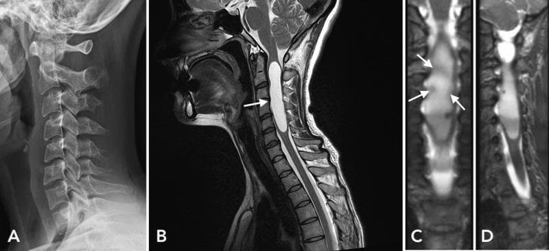 This composite figure presents multimodality clinical imaging of the cervical spine. (A) Lateral X-ray radiography demonstrates widening of the cervical spinal canal between the C3 and C5 vertebral levels, accompanied by mild degenerative spondylosis at C6-C7 and a slight kyphotic curvature. (B) A sagittal T2-weighted MRI reveals a significant hyperintense intramedullary lesion, consistent with a large syrinx, extending from C2 to C6. (C) Coronal T2-weighted MRI view identifies multiple small mural nodules along the margin of the cystic lesion, with arrows highlighting areas of potential contrast enhancement. (D) Corresponding sagittal MRI view provides longitudinal visualization of the cystic intramedullary mass. Collectively, these images illustrate the diagnostic features of a spinal intramedullary mass, specifically a cystic tumor with mural nodules (later pathologically confirmed as pilocytic astrocytoma) and its associated secondary effects on the spinal canal and vertebral alignment.
