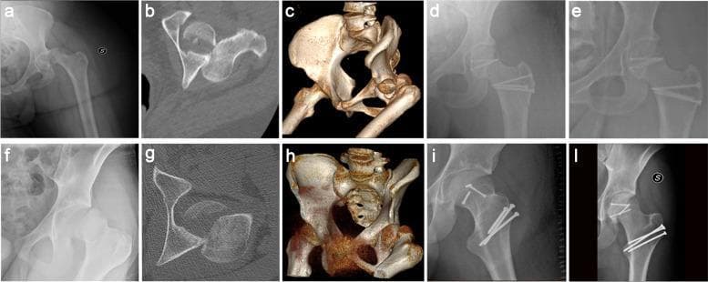 This composite of clinical images illustrates the diagnostic and surgical management of Pipkin type II femoral head fractures in two patients. Panels a-e follow a 33-year-old female, while panels f-l follow a 17-year-old male. The pre-operative imaging includes anteroposterior (AP) hip radiographs (a, f), axial CT scans (b, g), and 3D CT reconstructions (c, h), which clearly demonstrate displaced fractures of the femoral head cephalad to the fovea capitis. The axial CT and 3D views highlight the vertical fracture lines and intra-articular fragment displacement characteristic of Pipkin II injuries. The post-operative AP and lateral radiographs (d, e, i, l) display the results of open reduction and internal fixation (ORIF). Stabilization of the femoral head fragments is achieved using multiple headless compression screws (Herbert screws). Additionally, cortical screws are visible at the greater trochanter, indicating a Ganz trochanteric flip osteotomy used to gain surgical access through a Gibson approach. This sequence provides a comprehensive overview of orthopedic trauma imaging, fracture classification, and internal fixation hardware configuration for hip joint preservation.