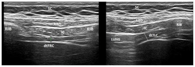 This diagnostic B-mode ultrasound side-by-side comparison illustrates the assessment of diaphragmatic thickness and contractility in a human subject. The images show a longitudinal view of the zone of apposition, typically between the 8th and 9th intercostal spaces. Layers from superficial to deep include subcutaneous tissue (SC), abdominal muscles (ABD), and intercostal muscles (IC) situated between the ribs (RIB), which present with characteristic hyperechoic surfaces and posterior acoustic shadowing. The diaphragm is visualized as a distinct three-layered structure: a hypoechoic muscular core bordered by two hyperechoic lines representing the pleural and peritoneal fascia. The left image demonstrates the diaphragm at Functional Residual Capacity (dt FRC) during end-expiration. The right image shows the diaphragm at Total Lung Capacity (dt TLC) during maximal inspiration, where the muscle appears significantly thicker due to contraction. In the inspiration view, the hyperechoic lung signal is visible as it descends into the costophrenic angle. This imaging technique is utilized in pulmonary and rehabilitation medicine to evaluate diaphragmatic function, atrophy, or paralysis.