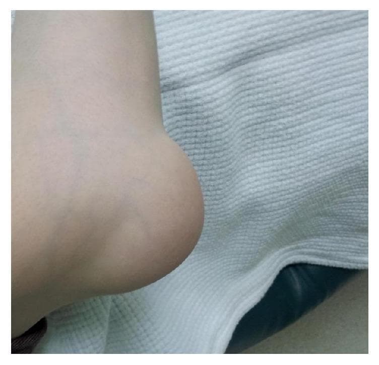 This clinical photograph displays a prominent, localized soft tissue swelling over the posterior aspect of the right elbow joint, consistent with olecranon bursitis. The swelling is large, hemispherical, and well-demarcated, significantly distorting the normal anatomical contour of the elbow. The overlying skin appears intact and relatively normal in color, without gross evidence of erythema, ulceration, or acute inflammatory changes. Bony landmarks of the elbow, such as the olecranon process, are obscured by the mass. This visual finding is characteristic of fluid accumulation within the olecranon bursa, which can occur due to trauma, repetitive pressure, or inflammatory and infectious conditions. The image serves as an educational example for musculoskeletal examination and the differential diagnosis of joint-related swellings.