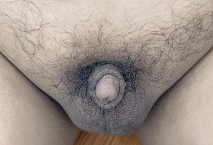 This clinical photograph shows the external genitalia of an adult male exhibiting signs of hypogonadism. The image demonstrates a microphallus (micropenis) with a significantly reduced penile length relative to the scrotum. The scrotum is intact and appears to contain small, prepubertal testes. Pubic hair distribution is sparse and primarily concentrated at the base of the penis, corresponding to Tanner stage 2 development, which is inconsistent with adult age. The skin of the genital region shows normal pigmentation without evidence of acute lesions. This visual presentation is characteristic of conditions involving delayed puberty or hypogonadotropic hypogonadism, such as Kallmann syndrome, where secondary sexual characteristics fail to fully develop due to hormonal deficiencies.
