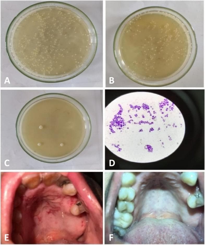 A multi-panel clinical and laboratory figure demonstrating the progression and treatment of oral candidiasis. Panels A, B, and C show Petri dishes containing agar medium with Candida albicans colony-forming units (CFUs). Plate A (baseline) shows confluent growth of small, cream-colored colonies. Plate B (one week post-treatment) shows a moderate reduction in colony density. Plate C (end of treatment) exhibits a marked decrease, with only a few isolated large colonies visible. Panel D is a high-power light micrograph of a Gram-stained smear showing characteristic purple-stained budding yeast cells and pseudohyphae. Panel E is a clinical photograph of the hard palate of a diabetic patient, revealing diffuse, erythematous candidiasis characterized by a bright red, inflamed mucosa with irregular borders. Panel F shows the same patient’s palate after treatment with miconazole-loaded chitosan nanoparticles, demonstrating clinical resolution with a return to a healthy, pink, smooth mucosal appearance and no visible inflammation.